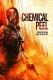 Chemical Peel